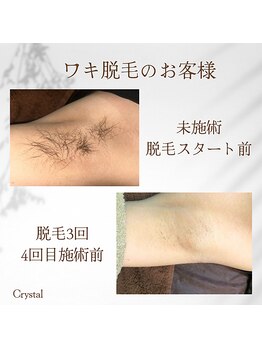 クリスタル(Crystal)/ワキ脱毛☆
