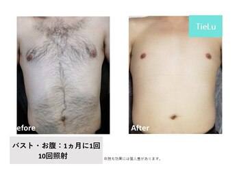 ティエル(TieLu)/上半身脱毛
