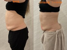 ココ(Coco)/脂肪冷却