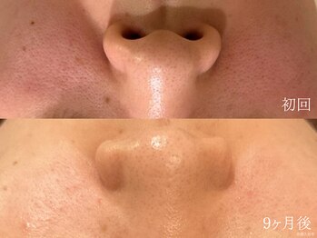 ウォーム(warm)/毛穴/毛穴洗浄/毛穴ケア/毛穴