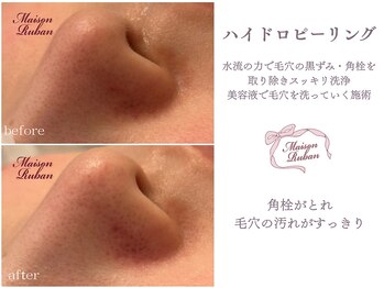 メゾンリュバン 梅田店(Maison Ruban)/毛穴洗浄|毛穴ケア