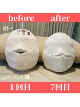 ロータス ビューティー(LOTUS Beauty)/石膏パックビフォーアフター