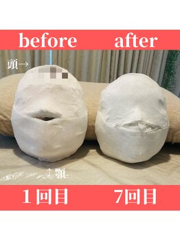 ロータス ビューティー(LOTUS Beauty)/石膏パックビフォーアフター