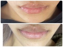 ラヴィ(Ravi)/唇エステ