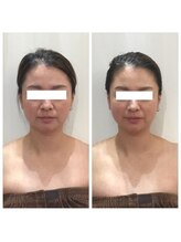 美肌脱毛エステサロン ベール 昭島店/小顔矯正