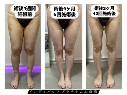 インディバケアプラチナム 心斎橋の写真