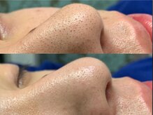 アンジェロ(Angelo)/大人気　毛穴吸引