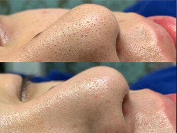 アンジェロ(Angelo)/大人気　毛穴吸引