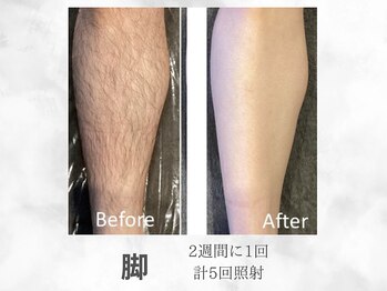 ベル(Belle)の写真/自己処理による肌荒れや毎日のお手入れから卒業!ムダ毛のお悩みにお任せください!