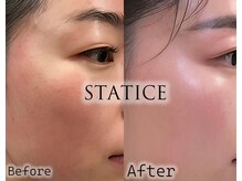 スターティス(STATICE)の雰囲気(天然由来成分のピーリング剤を使用した、オリジナル肌質改善)