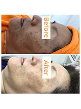 ヴィノス(VINOS)/シミケア効果★透明感UP