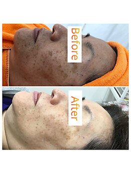 ヴィノス(VINOS)/シミケア効果★透明感UP