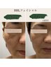 【シミケア】BBLフェイシャル（選べるパック付）×Ravissa使用で効果爆速！！