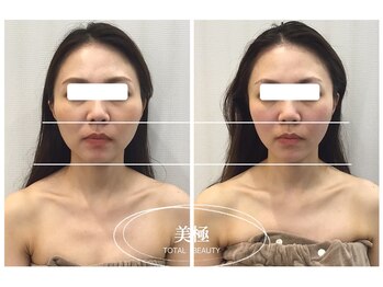 美極 トータルビューティー(美極 TOTAL BEAUTY)/恵比寿/小顔コルギ/エステ