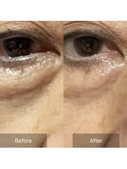 グリーンノート(GREEN NOTE)/ヒト幹細胞培養液65%1回目施術