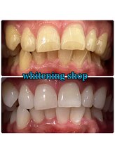 ホワイトニングショップ 郡山店/初めてのホワイトニング歓迎♪