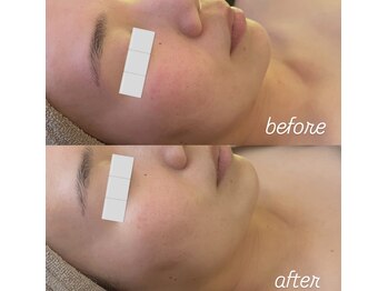 リノ(Lino)/陶肌トリートメントbefore after