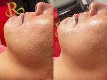 ゾーンビューティーハウス 柏店(ZONE BEAUTY HOUSE)/☆肌が変わる☆