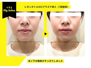 イエス マイサロン(yes My Salon)/レモンボトル施術例