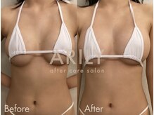 アリリィ(ARILY)/ダウンタイムケア/表参道/外苑前