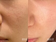 ウォーム(warm)/毛穴/毛穴洗浄/毛穴ケア/毛穴