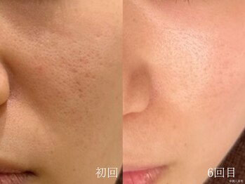 ウォーム(warm)/毛穴/毛穴洗浄/毛穴ケア/毛穴