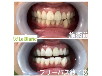 ルブラン 奈良店(Le Blanc)/黄ばみは大敵!!