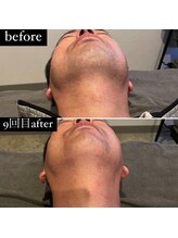 東京デトックス/【ビフォーアフター】ヒゲ脱毛