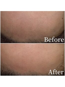 ユカリス(Yu.charis)/FWT ワックス脱毛before→after