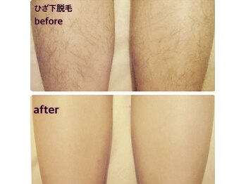 ラウレア 西条店(LAULEA)/ひざ下脱毛(befor/after)