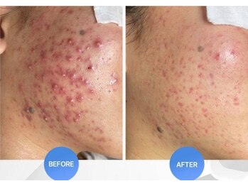 ビーシェイプ 君津(B-Shape)/症例【ハーブピーリング】