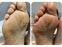 ロンディネ(Rondine)/韓国式足裏角質ケア