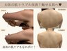 【モニター様】 背中の黒ずみ・赤み｜肌質改善ピール5回 ¥77,000→¥49,800
