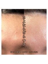 サロンドオフ 西梅田(salon de off)/額のざらつきのビフォーアフター