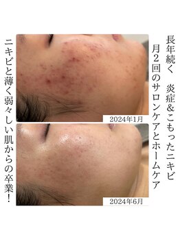 ルーナ ジェーナ(Luna llena)/こもりニキビケアにもエルモサ