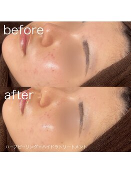 ルルラ リコ(lulula rico)/症例写真/ハーブピーリング