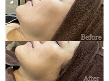 トリンテ バイ フェース(TRINTE by FAITH)/【表情筋ケアでたるみ毛穴】1回