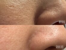 ウォーム(warm)/毛穴/毛穴洗浄/毛穴ケア/毛穴