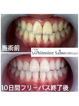 ホワイトニングサロン 京都烏丸店/ホワイトニング施術例