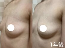 ハレオラ(HaleOla)/お客様の変化☆バストケア