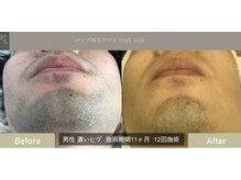 ハイリンク(High Link)/《ひげ脱毛》before→after