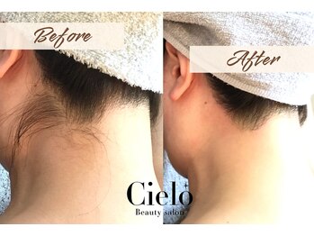 シエロ 赤坂店(Cielo)/ うなじ脱毛