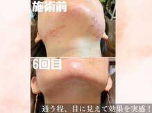 美肌研究所 東京新宿支店/フェイスラインしつこいアクネ菌