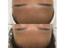 《光フェイシャル》おでこのにきび改善に◎2回照射でこの効果!