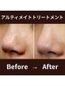 【8月限定】本気の黒ずみ徹底ケア♪毛穴のプロによる職人技◎¥8250