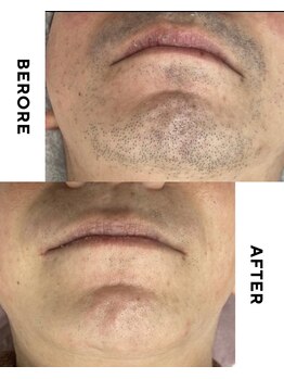 ゼロ 水戸店(ZERO)/ヒゲ脱毛★before&after 