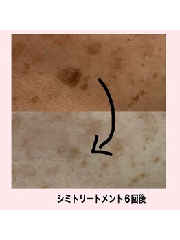 サロンドミジュ(Salon de 美jyu)/シミケア