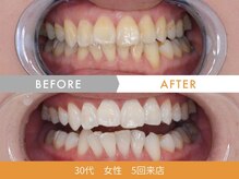 ホワイトニングセンター 札幌白石/ホワイトニングビフォーアフター