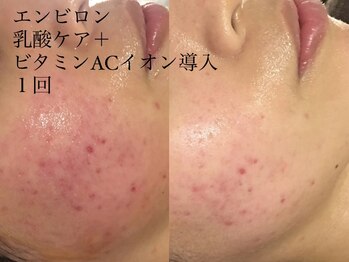 シュリー(Sriii)/エンビロン乳酸ケア+イオン導入