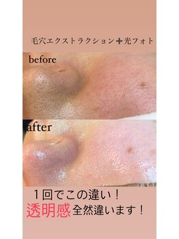 アトレ(Atre)/毛穴ケア×光フォト！最強すぎ！